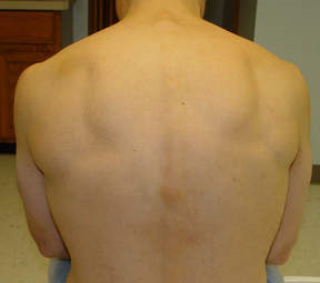 laser hair removal after nyc